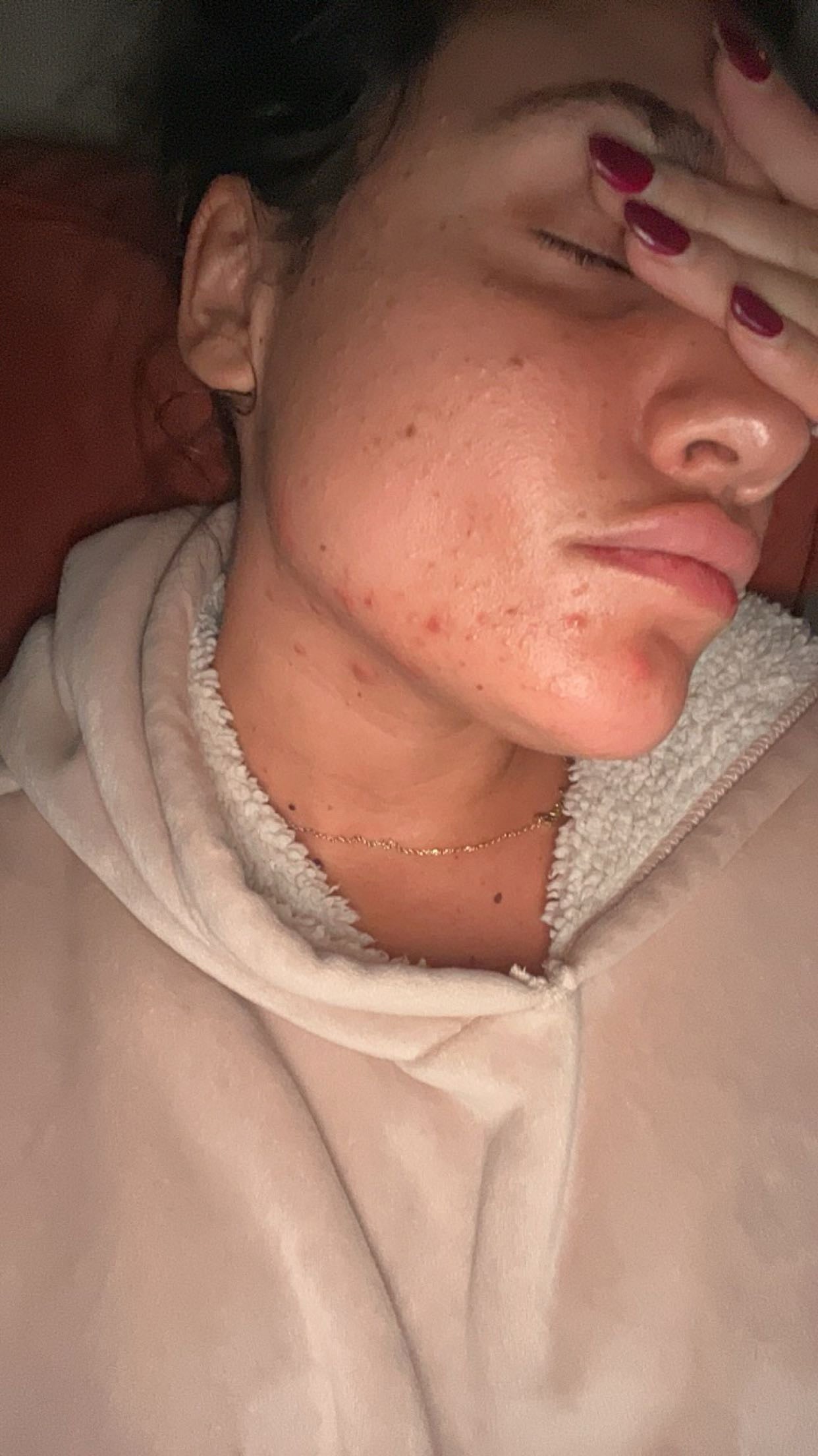 Résultats avant/après acné hormonale – ACNICELL