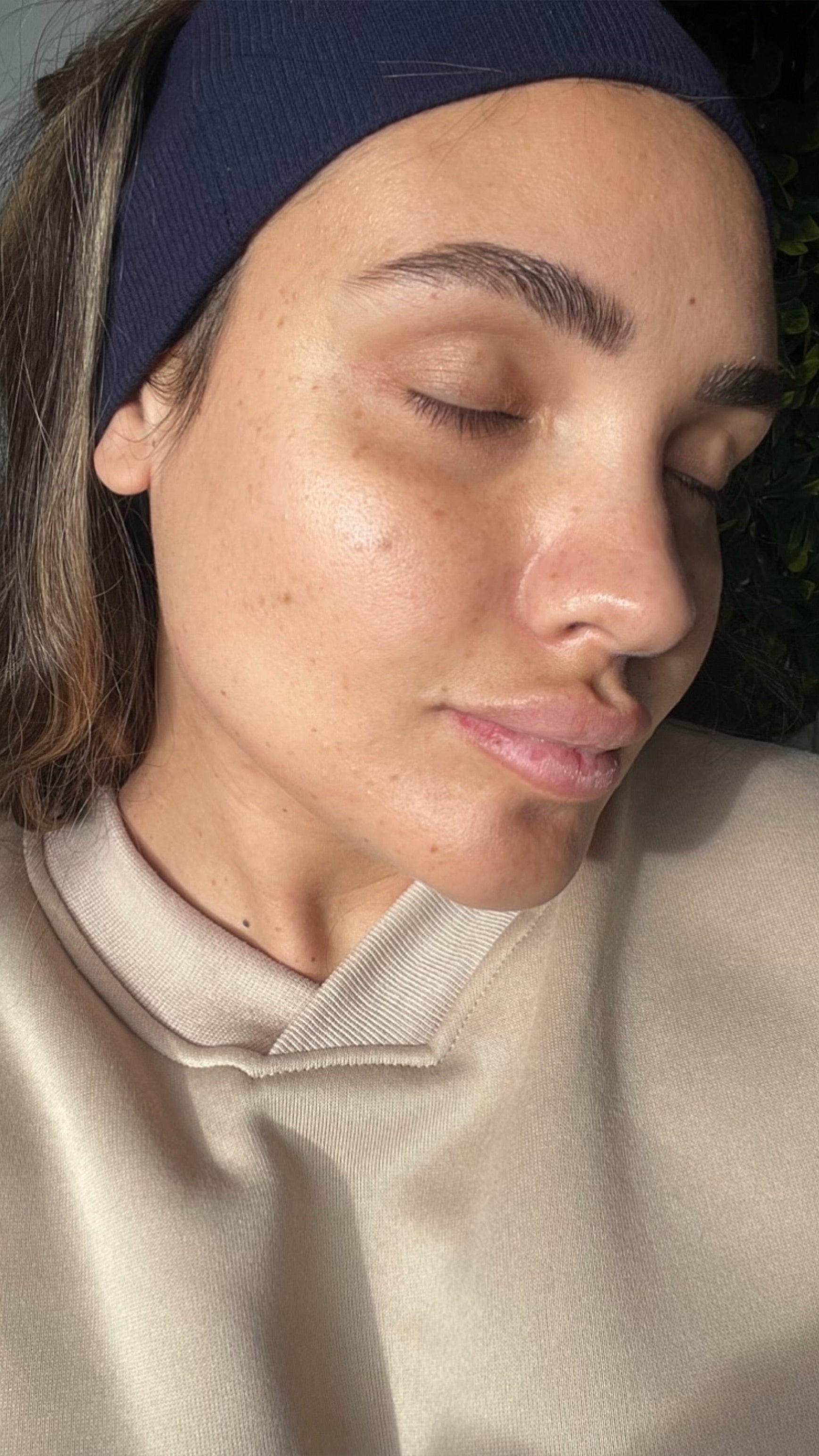 Résultats avant/après acné hormonale – ACNICELL